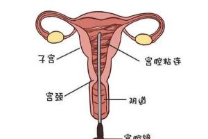 做了宫腔粘连分离手术多久才能做试管婴儿？时间不是关键