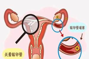 输卵管堵塞能做试管么？看完你就清楚了
