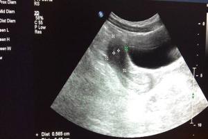 幼稚子宫能不能做试管婴儿好孕？需结合实际情况而定