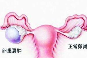 卵巢囊肿能怀孕吗？具体还要视情况而定。