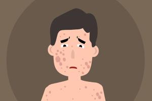 专项科普：试管婴儿能避免遗银屑病吗？