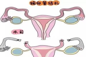 女性做了输卵管结扎能做试管婴儿吗-当然可以