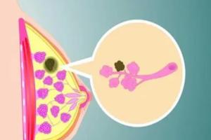深度解析乳腺结节3类能否做试管婴儿