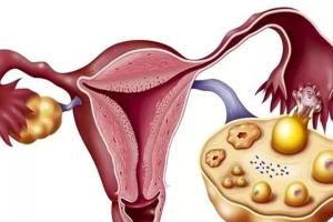 多囊卵巢综合症试管婴儿成功率有多少?并不是决定性因素