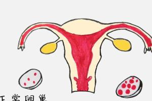 试管促排多囊怎么预防空卵泡？专家支招三个方法请查收！