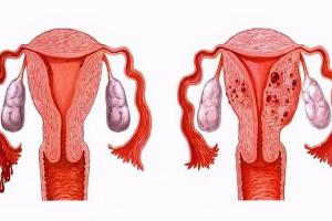 腺肌症还能做试管婴儿吗？专家建议先治疗