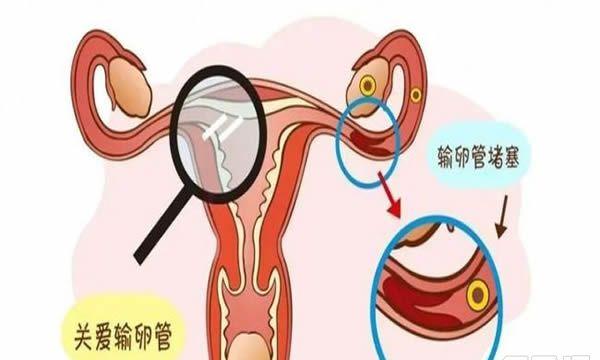 输卵管不通的9种自测方法-出现这3种情况要引起重视