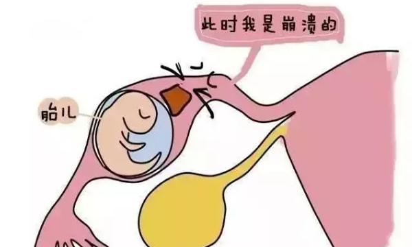 试管可以完全杜绝宫外孕吗？不能！但比自怀发生宫外孕的风险低！