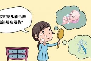 三代试管婴儿可以筛除银屑病吗-可以但要注意检查