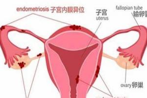 专家解读女性患有子宫内膜异位症影响做试管婴儿吗（内附成功率）