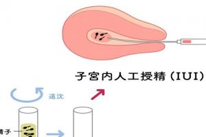 小蝌蚪找爸爸之人工授精如何优化精子