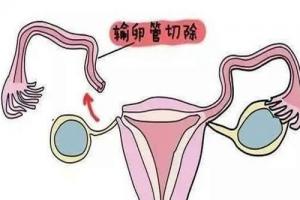 专家科普女性没有输卵管同样可以做试管婴儿当妈妈