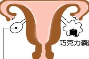 女性常见的疾病之一巧克力囊肿，能做试管婴儿吗