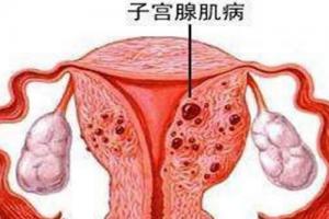 子宫腺肌症还能做试管婴儿吗-当然是越早越好