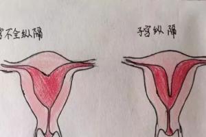 分享临床医师手绘子宫畸形图，让你对畸形子宫的类型过目不忘