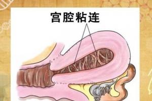 盘点引发宫腔粘连的4大因素-建议女性都要了解