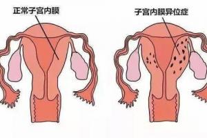 子宫内膜异位症做试管婴儿成功率高吗-看完让你信心倍增