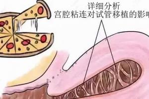 详细分析宫腔粘连对试管移植的影响