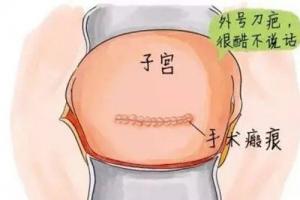瘢痕子宫怀孕生二胎的注意事项