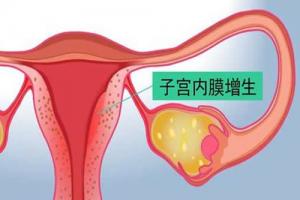 子宫内膜增生可以做试管婴儿吗？听听医生怎么说
