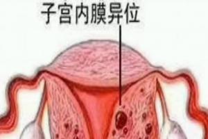 女性朋友要警惕子宫内膜异位症引起的不孕症!