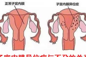 浅谈子宫内膜异位症与不孕的关系-生殖知识科普