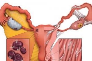 专家解读内异症-良性癌症的恶性后果