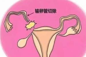两侧输卵管切除还能做试管生育吗？生殖专家科普