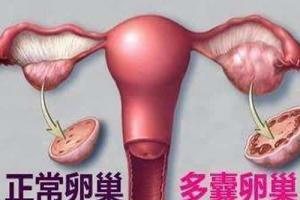 多囊专家解说-多囊卵巢综合症7大细节症状详解