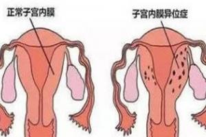 子宫内膜异位症能做试管婴儿吗？成功率高吗？一文给你说清楚