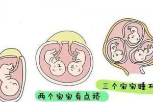 警惕，试管在这五种情形下需要减胎，准妈妈要注意了！