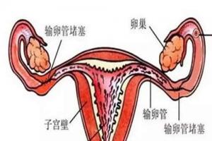 生殖知识科普：输卵管不通做试管成功率多少？