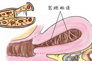 详解宫腔粘连常见的4个症状！