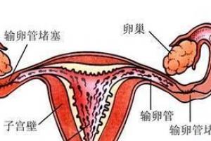 输卵管疾病导致女性不孕的5大因素-汇总分享