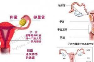 动漫解析子宫内膜异位症是如何形成的