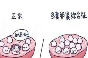 多囊卵巢做试管婴儿前的注意事项汇总，都在这里了