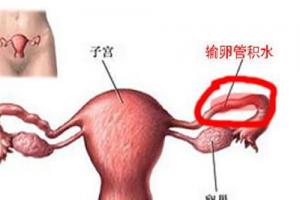 输卵管积水与不孕症的利害关系-专家解读