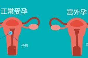 宫外孕后建议直接试管?真相不是这样的,听听专家怎么说