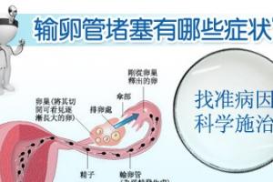 输卵管梗阻与不孕症关联的详细解读