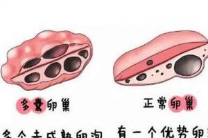 卵巢多囊综合征的4个起因和5个症状「医学剖析」