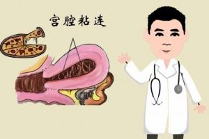 宫腔粘连产生的原因是什么怎么治?这篇文章让你了然于心