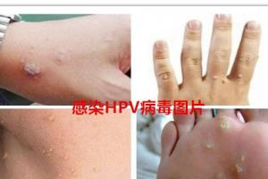 什么是HPV病毒携带者(附HPV病毒感染的症状图片)