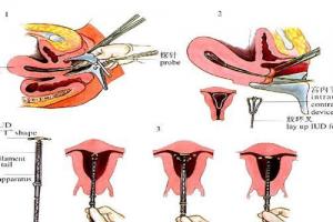 为什么上环（节育器）能避孕？节育器有几种？附图片