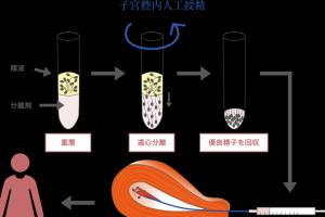 人工授精的过程与费用详细介绍