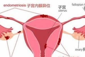 子宫内膜异位症是什么呢？ 该如何治疗？