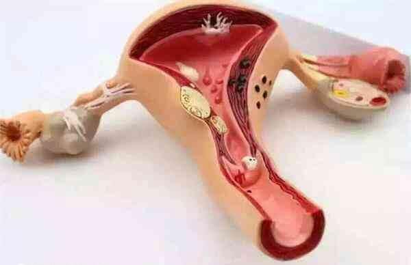 腺肌症试管成功了怎么保胎