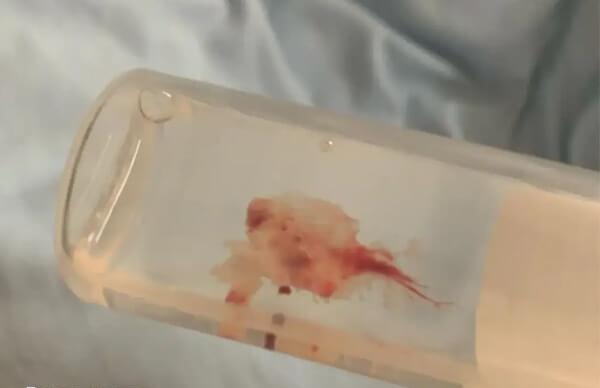 胚胎绒毛怎么储存送检
