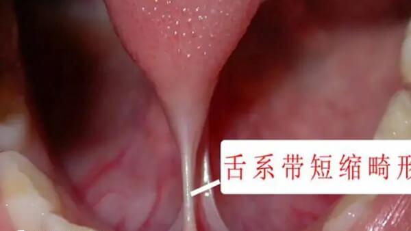 舌系带过短症状有哪些