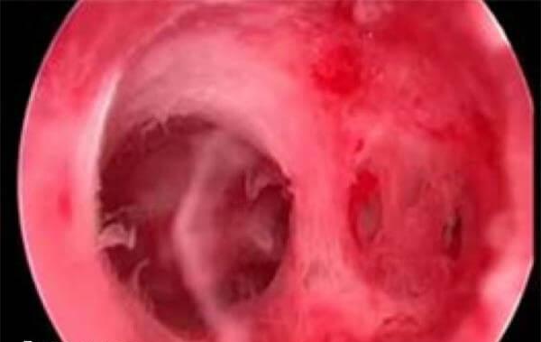 流产后宫腔粘连的症状有哪些