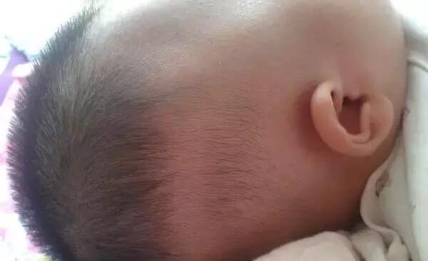 宝宝枕秃是不是缺钙